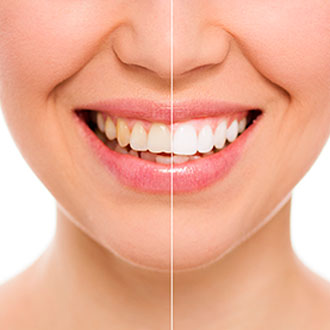 Blanqueamiento Dental