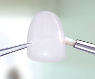 Implantes Dentales